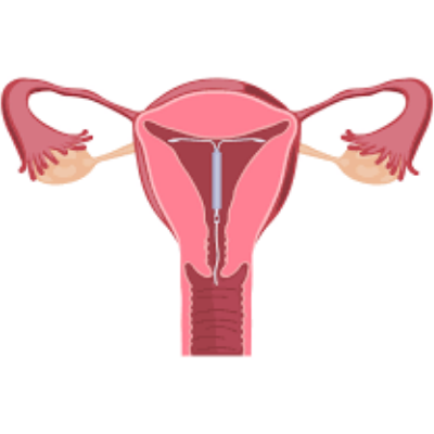 uterus with IUD 