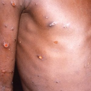 What's Nigeria's Business With the Monkeypox Virus?