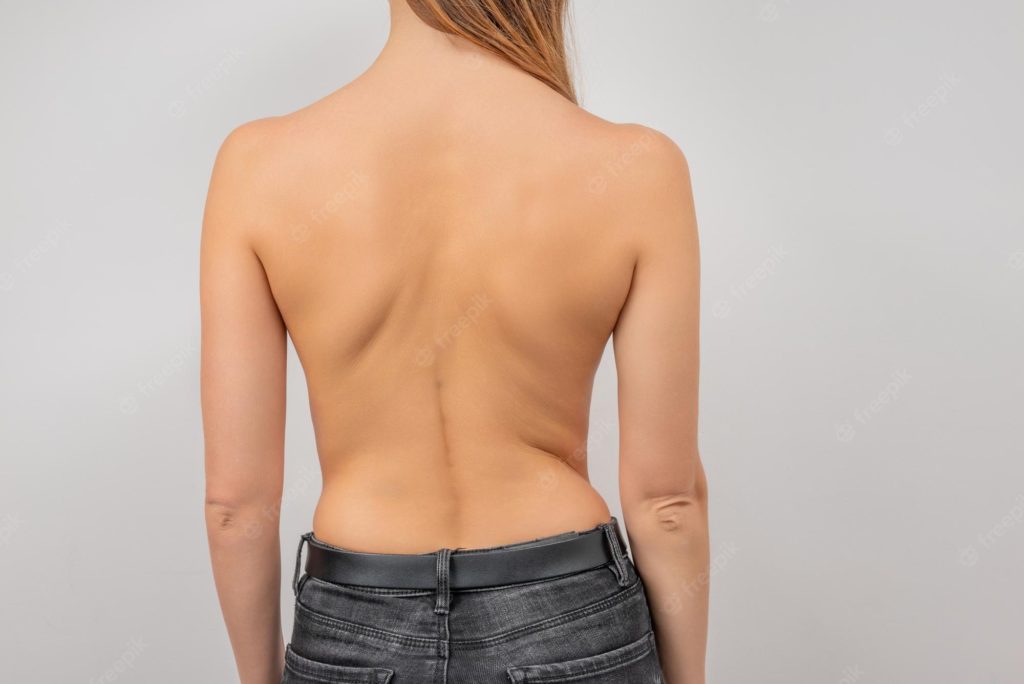 Image of the back of a woman showing her curved spine